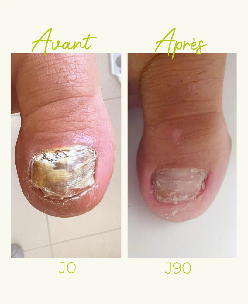 Ongles jaunis, abîmés - Image 4